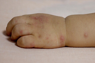 Mụn nước nhỏ, tròn, màu hồng trên bàn tay và cổ tay của trẻ do bệnh tay chân miệng.Nguồn ảnh: www.nhs.uk