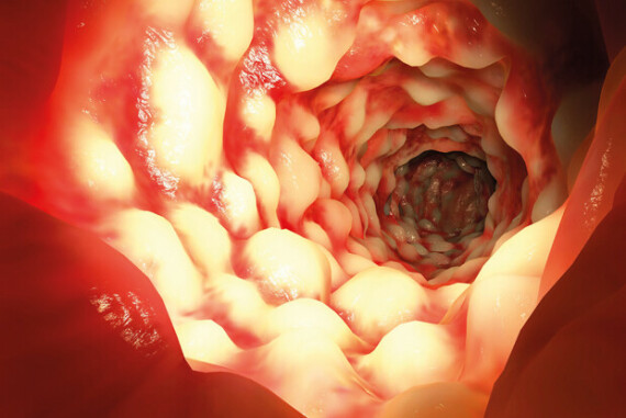 Hình ảnh nội soi trực tràng bệnh nhân Crohn – Nguồn ảnh: gponline.com