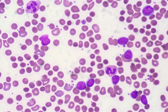  Thiếu máu tan máu là tình trạng mà tế bào máu bị phá vỡ với tốc độ quá cao. Nguồn ảnh: Lecturio.com