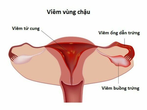 Viêm vùng chậu ở phụ nữ bao gồm viêm tử cung, viêm ống dẫn trứng và viêm buồng trứng – Nguồn ảnh: planetayurveda.com