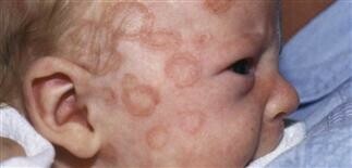 Một số phụ nữ mắc lupus sinh con bị lupus sơ sinh (Nguồn ảnh: plasticsurgerykey.com)