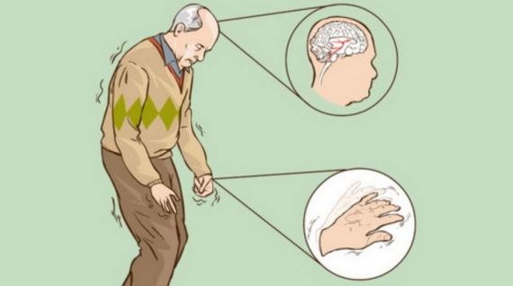 Amatadin thường được sử dụng để điều trị bệnh Parkinson