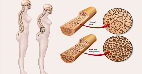Alvethicone Tab phòng và điều trị loãng xương ở phụ nữ