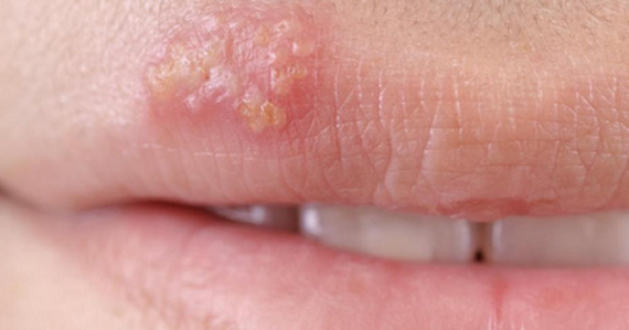 Thuốc Aciherpin được dùng để bôi ngoài da trong trường hợp herpes môi