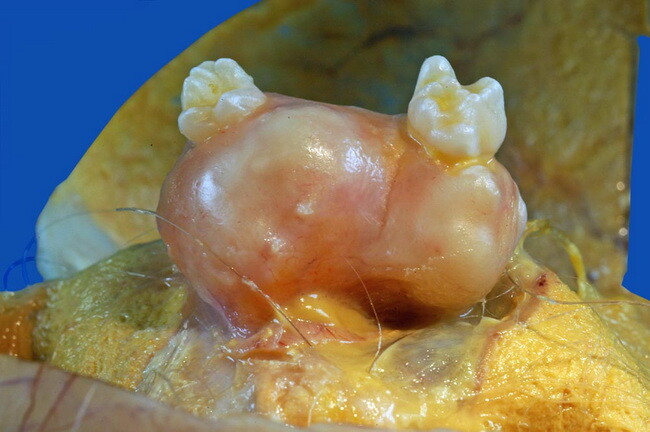 Có thể phẫu thuật nội soi hoặc phẫu thuật mở để điều trị u bì buồng trứng. Nguồn ảnh: Webpathology.com.