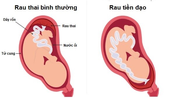 Nguồn ảnh whattoexpect.com