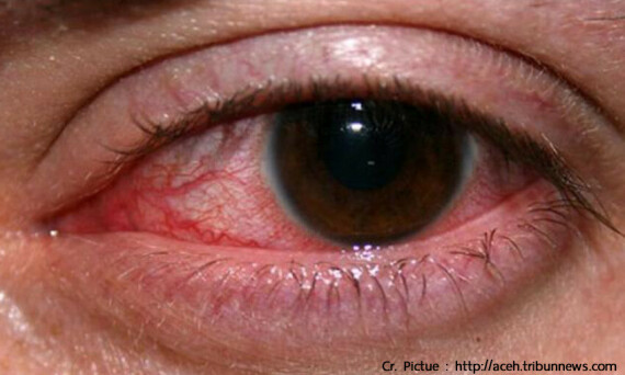 Thuốc có thể gây bỏng rát mắt khi dùng. Nguồn: rutnin.com