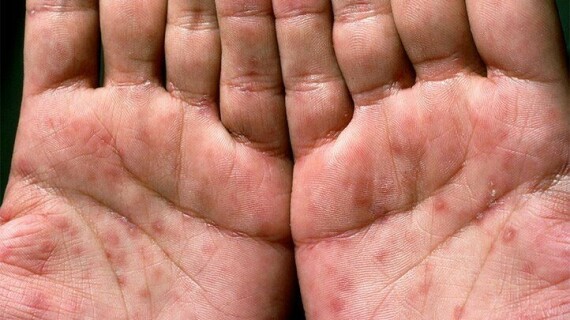 Hình minh họa các nốt phát ban ở lòng bàn tay gặp trong bệnh giang mai (Nguồn ảnh  từ Everydayhealth).