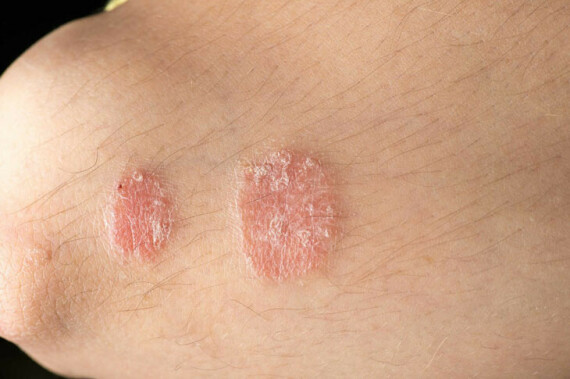 Agiketo thường được dùng để điều trị nhiễm nấm ở da