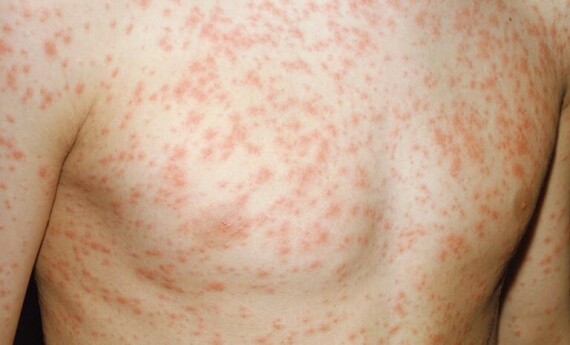 Sử dụng thuốc Acemol có thể gây nổi mẩn đỏ trên da