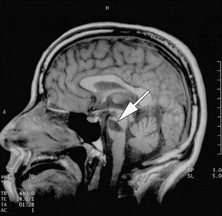 Tổn thương thân não trên phim chụp MRI. Nguồn ảnh archives-pmr.org