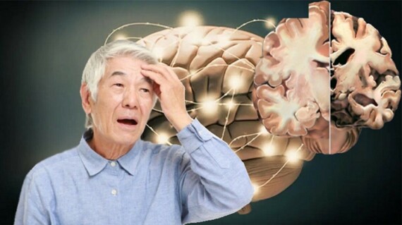 Thuốc Citicoline dùng để điều trị bệnh Alzheimer