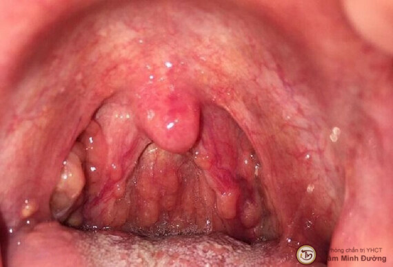 Aegenklorcef được chỉ định trong nhiễm khuẩn hô hấp trên như viêm họng
