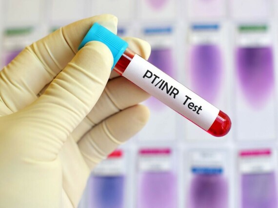 Tỷ prothrombin (PT) là xét nghiệm máu giúp đo thời gian đông máu. Nguồn ảnh: capacitacionesonline.com