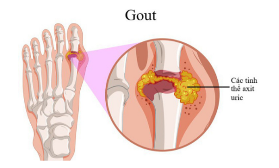 Các triệu chứng của viêm khớp cấp tính do gout có thể được cải thiện khi dùng thuốc Alavox