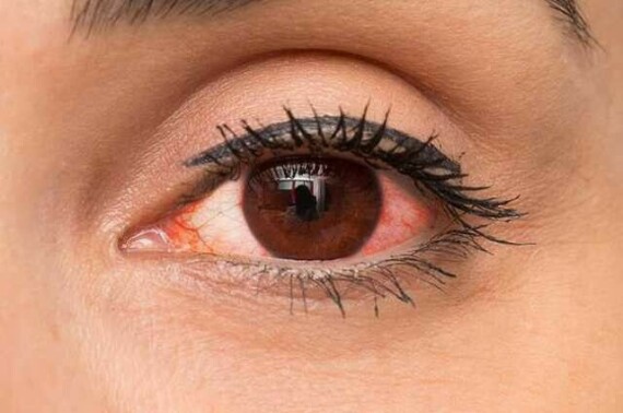 Thuốc được chỉ định dùng để điều trị nhiễm trùng mắt