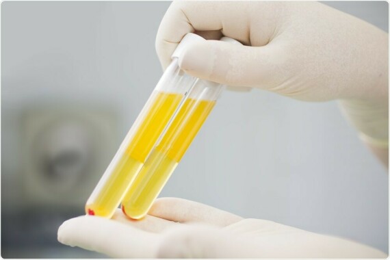 Xét nghiệm huyết tương có thể giúp chẩn đoán thiếu kẽm. Nguồn ảnh: news-medical.net.com
