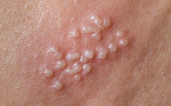 Thuốc Aclocivis được dùng bôi ngoài da ở bệnh nhân nhiễm Herpes simplex trên da