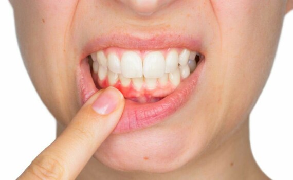 Sử dụng thuốc có thể gây tác dụng phụ là chảy máu chân răng