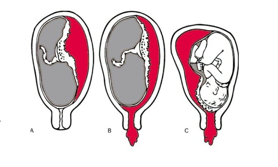 Hình: Bóc tách túi thai: A. Chưa chảy máu;  B và C: Có chảy máu. Nguồn: An Thái Phương