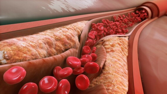 Alvasta điều trị giảm cholesterol toàn phần
