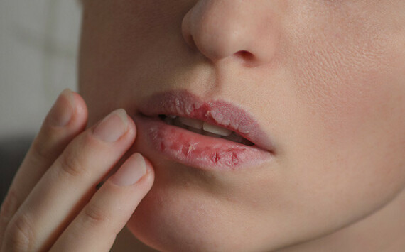 Bệnh nhân thường bị nẻ môi khi sử dụng thuốc Acitretin