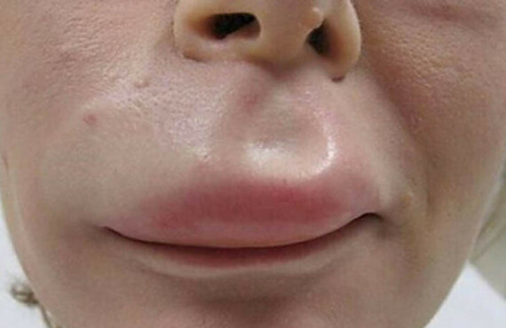 Perindopril gây tác dụng phù mạch ở mặt ,môi