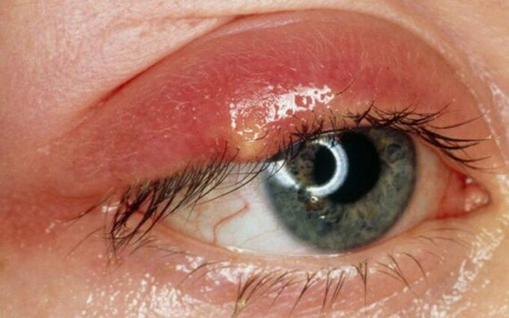 Thuốc Boric acid chỉ định điều trị trong viêm mi mắt