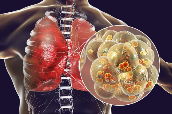 Alpodox được chỉ định dùng trong điều trị viêm phổi do vi khuẩn nhạy cảm gây ra