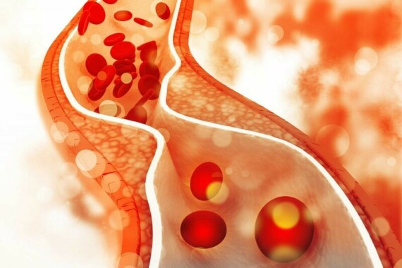 Agisimva  điều trị tăng cholesterol máu nguyên phát