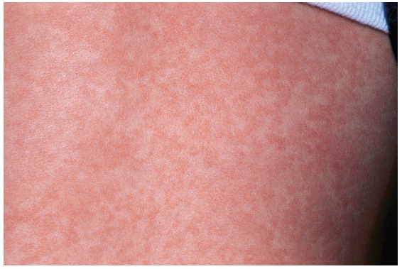Thuốc Agitritine có thể gây phát ban trên da trong một số trường hợp