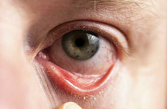 Thuốc Acular có thể làm giảm tạm thời triệu chứng ngứa mắt do viêm kết mạc dị ứng theo mùa