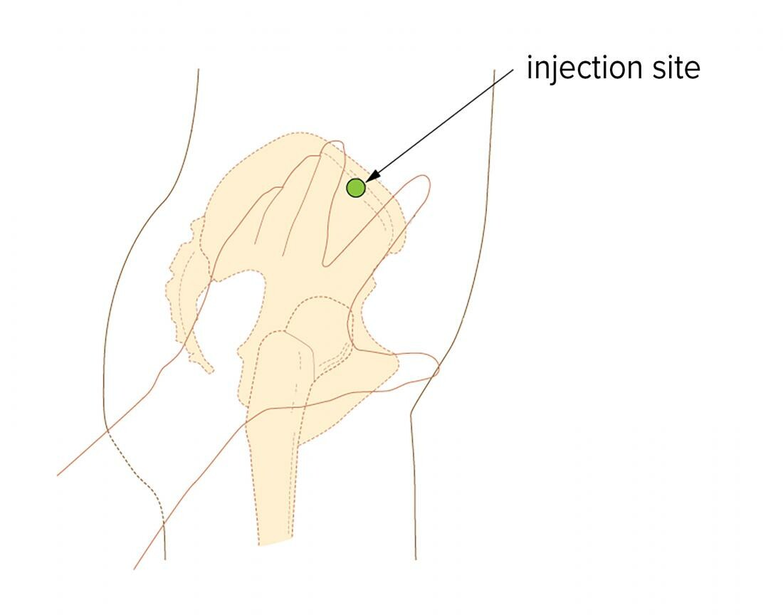 Các bác sĩ thường tiêm bắp vào cơ bụng của vùng hông (vị trí chấm xanh) (nguồn: https://www.medicalnewstoday.com)