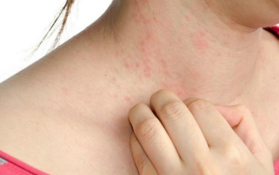 Sử dụng Alpharmebisin có thể gây dị ứng ngoài da