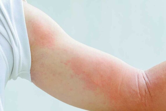 Sử dụng piperacillin có thể gây phản ứng dị ứng phát ban ở da