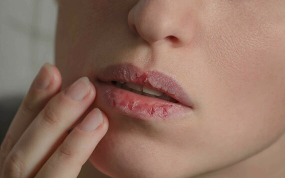 Khô miệng có thể đi kèm nẻ môi, lở miệng. Nguồn: diabetes.co.uk