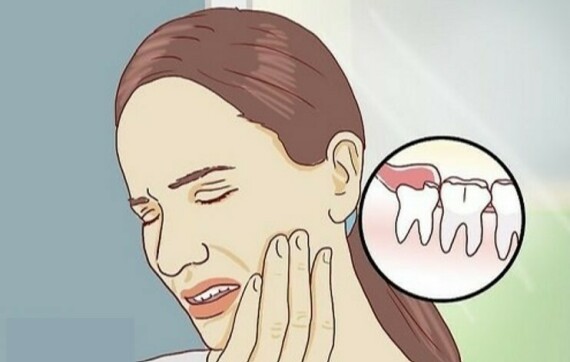 Viêm lợi trùm thường gây sưng đau hàm