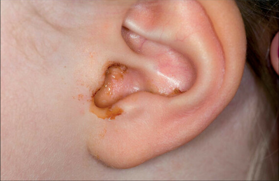 Thuốc được chỉ định điều trị viêm tai giữa.