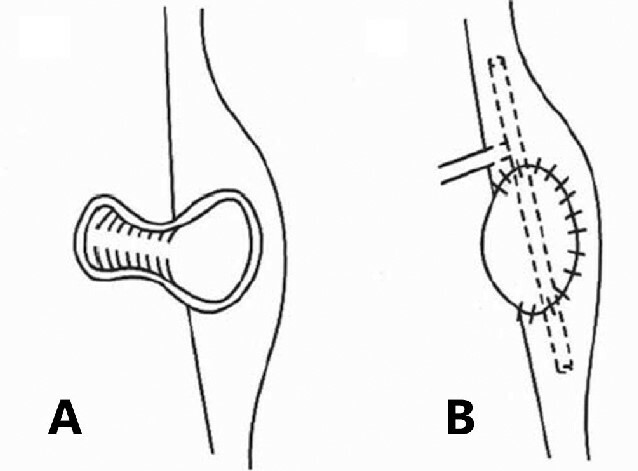 Hình ảnh minh họa vị trí đặt dẫn lưu Kehr trong phẫu thuật sỏi ống mật chủ (Nguồn ảnh từ researchgate)