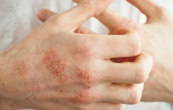 Bệnh eczema.