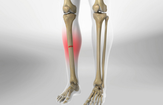 Gãy xương chày thường xảy ra do chấn thương nặng, trực tiếp tác động vào xương. Nguồn ảnh: Healthline