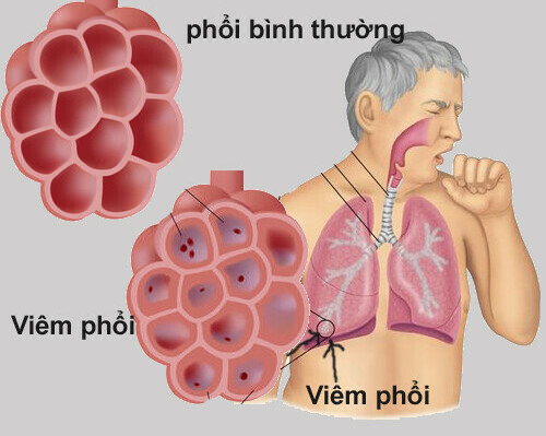 Viêm phổi điển hình và Viêm phổi không điển hình | BvNTP