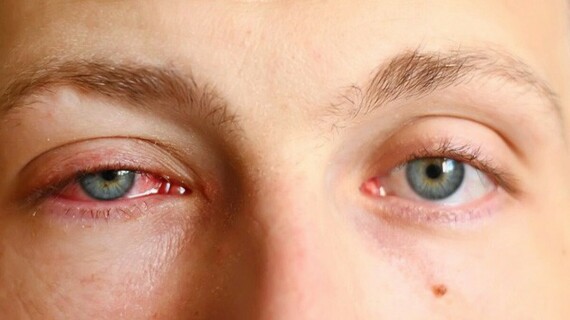 Sử dụng Dex Tobrin Eye Drop có thể gây sưng mí mắt