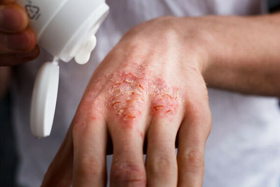 Baribit được dùng để điều trị các triệu chứng do bệnh ngoài da