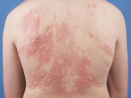 Phát ban trên da là một trong những triệu chứng của dị ứng. Nguồn ảnh: https://www.pinterest.com