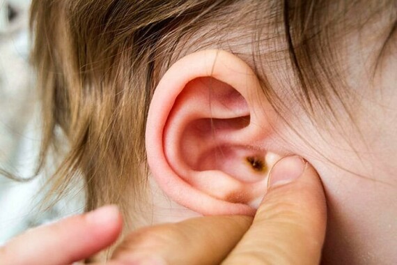 Những triệu chứng của viêm tai ngoài có mủ cần phải biết