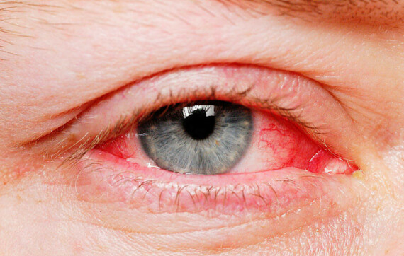 Thuốc được chỉ định trong viêm kết mạc mắt