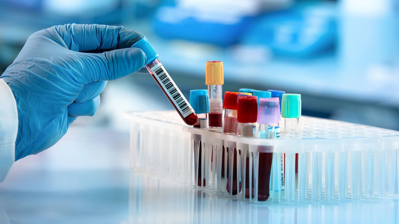 Xét nghiệm máu giúp xác định kháng thể HBeAb. Nguồn ảnh: Medscape Education