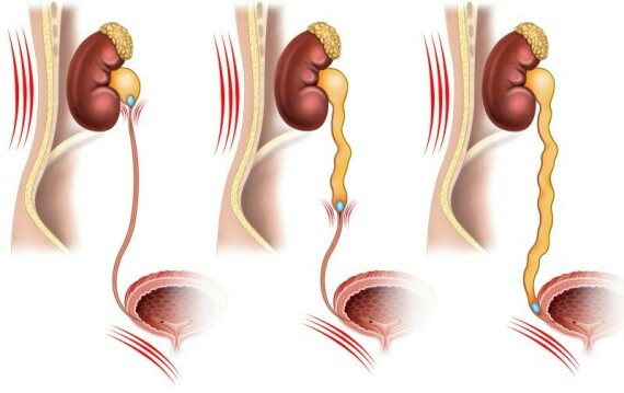 Sỏi niệu quản (nguồn: https://specialty.mims.com/)