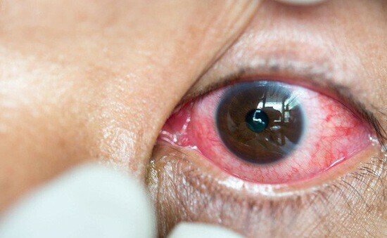 Dex Tobrin Eye Drop thường dùng để điều trị nhiễm khuẩn mắt